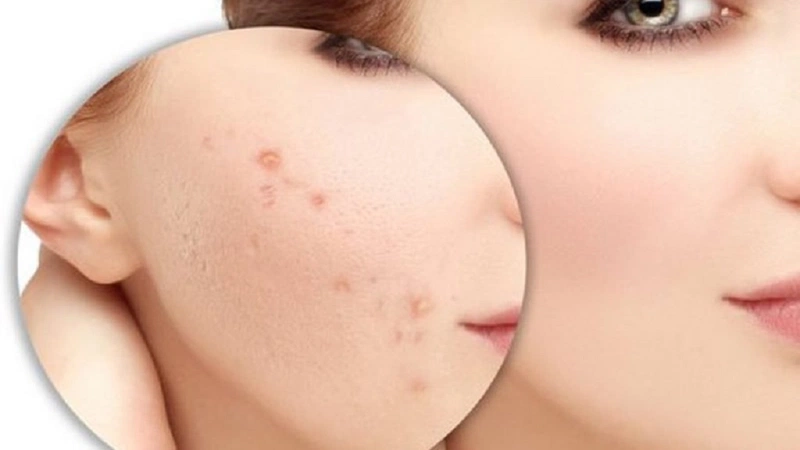 Hỗ trợ làm dịu da, giảm vết đỏ sau mụn
